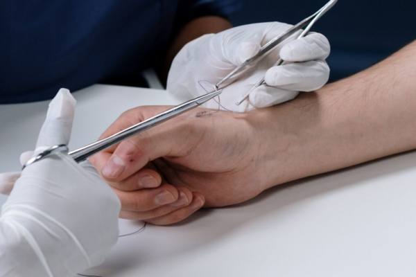 When Does A Cut Require Stitches?
