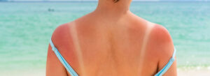 Sunburn Treatment and Prevention Facts