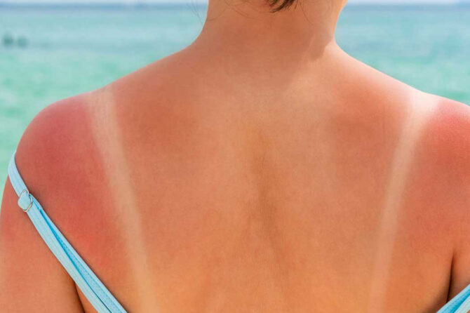 Sunburn Treatment and Prevention Facts