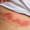 Shingles: Causes Symptoms and Treatment