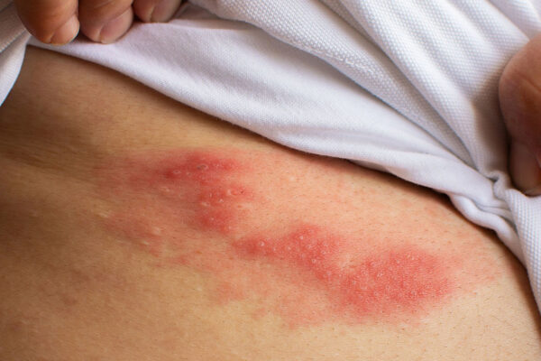 Shingles: Causes Symptoms and Treatment