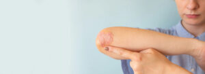 What is Ringworm: Symptoms and Treatment