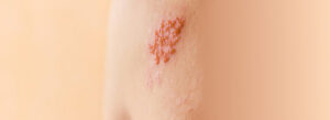 Facts About Shingles: Is Shingles Contagious?