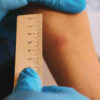 Convenient TB Tuberculosis Testing at Urgent Care