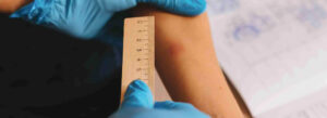 Convenient TB Tuberculosis Testing at Urgent Care