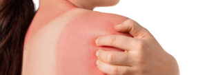 Urgent Care Sunburn Treatment: When to Seek Help